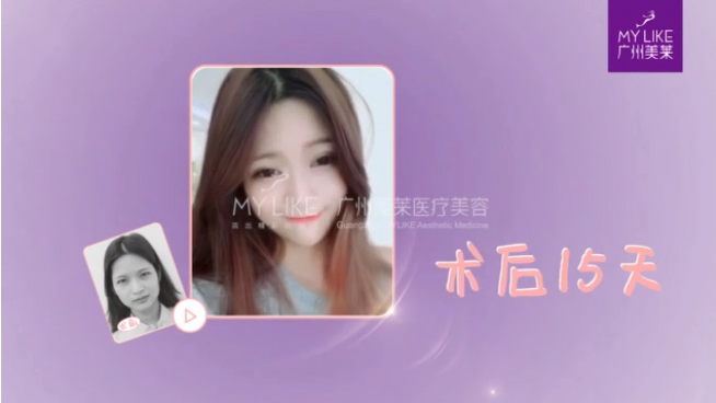 广州和记AG平台怡情娱乐官网双眼皮案例带你观看美女改变全过程