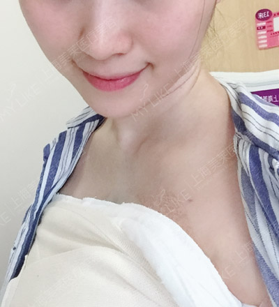 Vicky复合丰胸