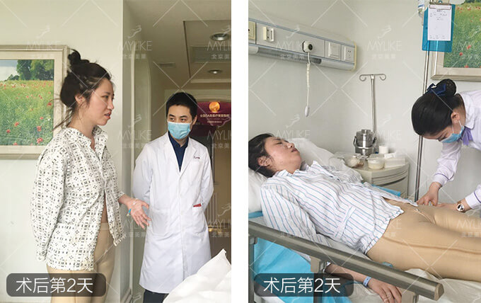 小岳岳呀大腿抽脂减肥+北京和记AG平台怡情娱乐官网吸脂瘦腿案例