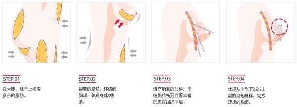 广州自体脂肪丰胸效果好不好呢