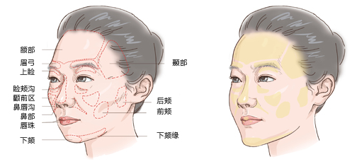 自体脂肪面部填充哪里较好呢