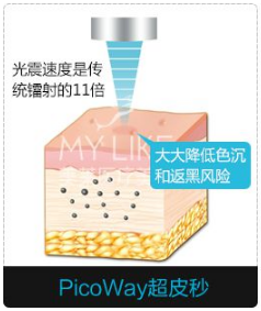 深圳超皮秒激光祛斑做几次好