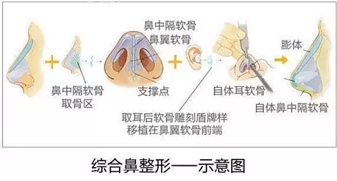 深圳和记AG平台怡情娱乐官网鼻综合整形有哪些呢