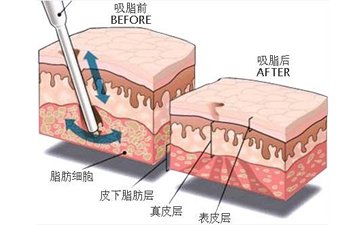 做抽脂减肥有什么危害