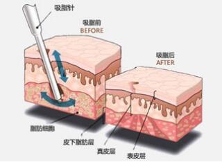 <a href='/fs/' target='_blank'><u>佛山和记AG平台怡情娱乐官网</u></a>手臂吸脂有副作用吗