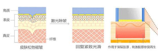 深圳做激光除皱对皮肤能造成伤害吗