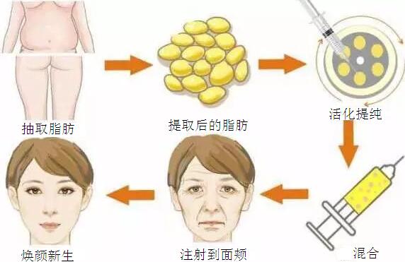 佛山的自体脂肪填充苹果肌会有后遗症吗