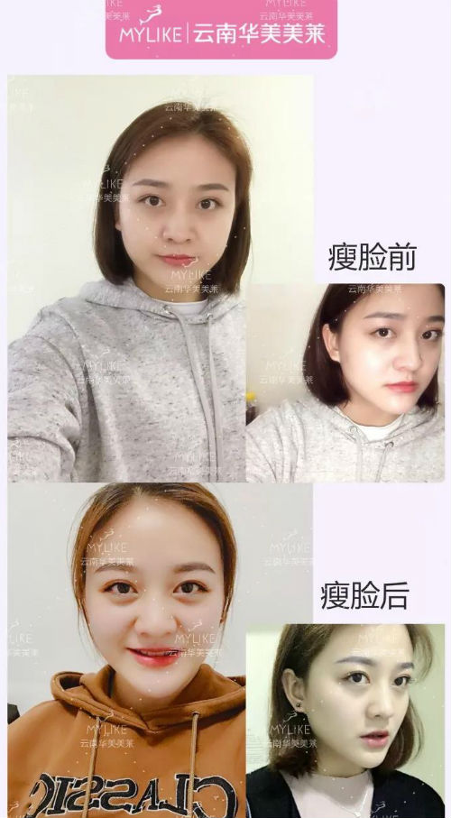 打完瘦脸后什么时候才会有效果