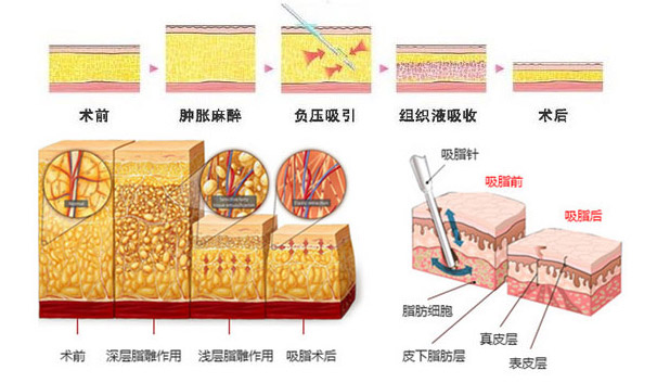 广州和记AG平台怡情娱乐官网吸脂减肥术后效果行不行呢