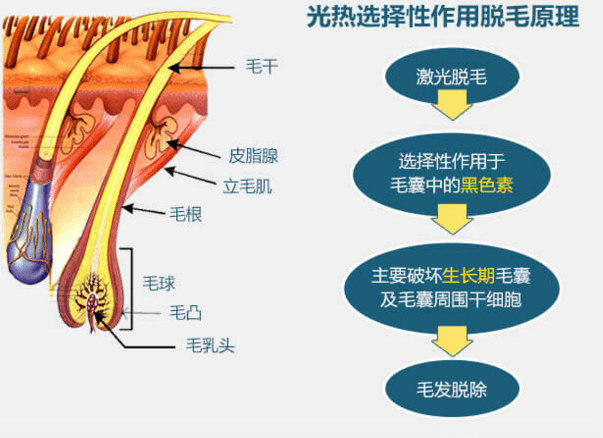 重庆华美腿毛太多如何持久脱毛