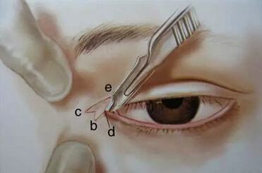 成都开内眼角会伤害到眼睛吗