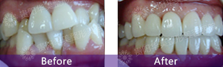 贵阳哪家医院做矫正牙齿前突效果好呢