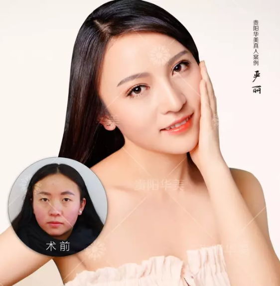 贵阳激光美白美容手术费用要多少钱呢