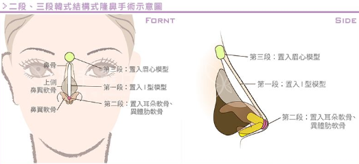 沈阳自体组织隆鼻那个效果比较好