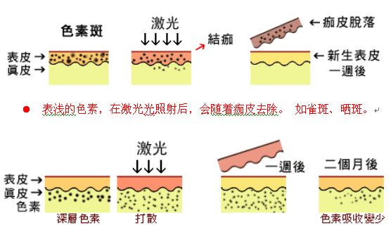 去色斑需要多少钱