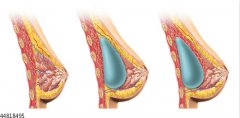 怎样让隆胸手术恢复比较快