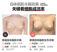 昭通做自体脂肪丰胸，怎么提高脂肪存活率