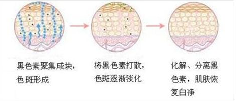 上海激光去斑会有后遗症吗