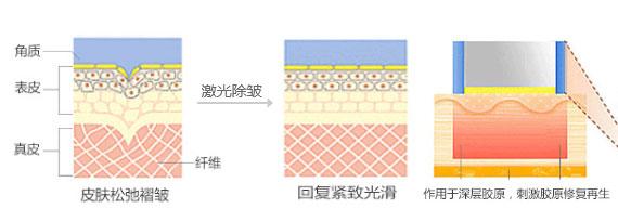 西安面部除皱失败了怎么修复