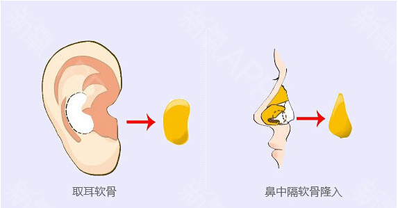 自体软骨隆鼻