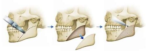 下颌角整形手术