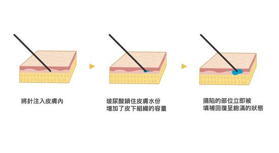 注射玻尿酸除皱