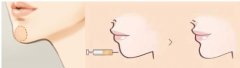 成都自体脂肪丰下巴会留下后遗症吗
