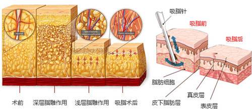 沈阳做抽脂减肥术后有哪些护理工作