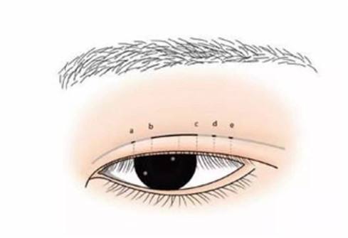 福州做全切双眼皮术后需要注意事项有哪些