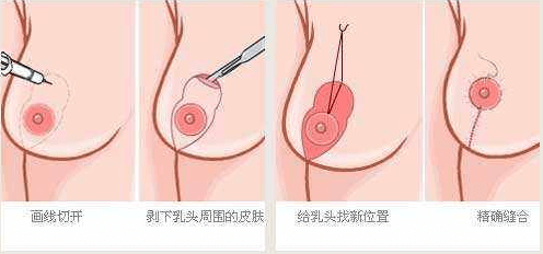 乳房下垂有些严重应该怎么办