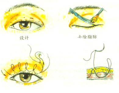 沈阳做微创双眼皮手术后的效果怎么样