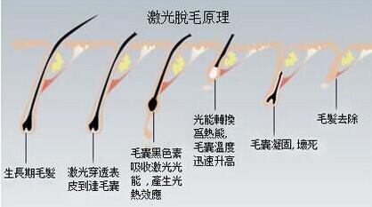 厦门激光脱毛几次效果能持久