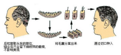 成都植发