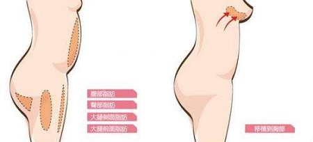 怎么进行乳房再造