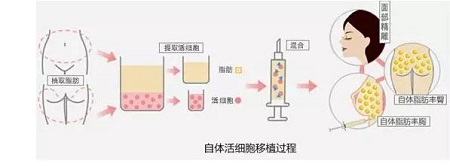 吸脂丰胸多少钱