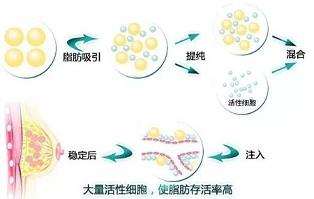 自体丰胸手术价格