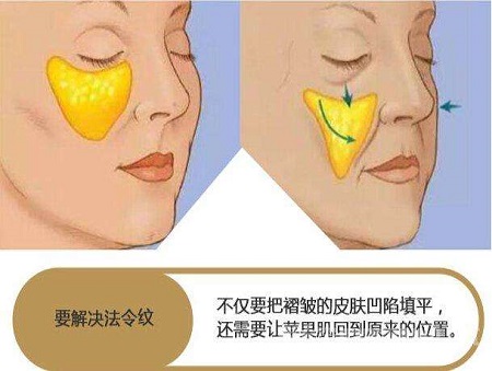 脂肪填充法令纹能维持多少时间？