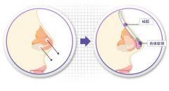 成都假体隆鼻手术的价格会很贵吗