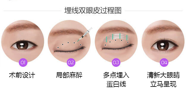 埋线双眼皮的效果可以维持多少年呢