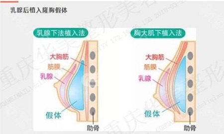 假体丰胸失败修复价格