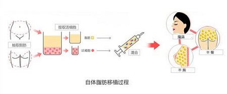 注射玻尿酸填充鼻唇沟