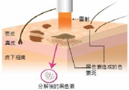 激光祛雀斑价格是多少呢