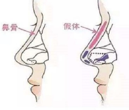 做假体隆鼻手术以后鼻子