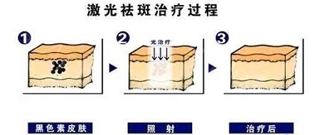 激光除皱