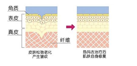 激光除皱