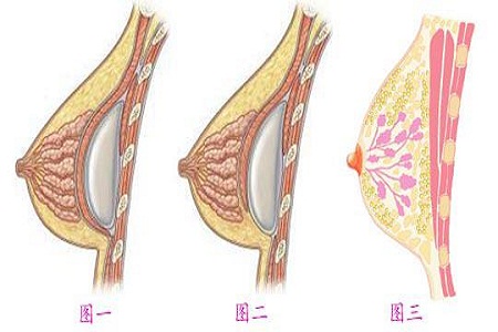 乳头内陷矫正