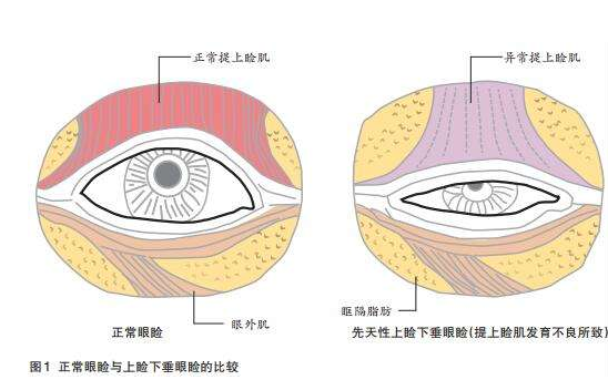 上脸下垂矫正