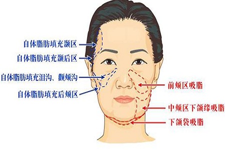 脂肪填充脸部