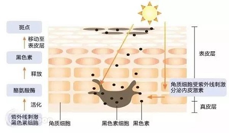 黄褐斑