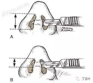 隆鼻手术切口在哪里？才能自然不留疤